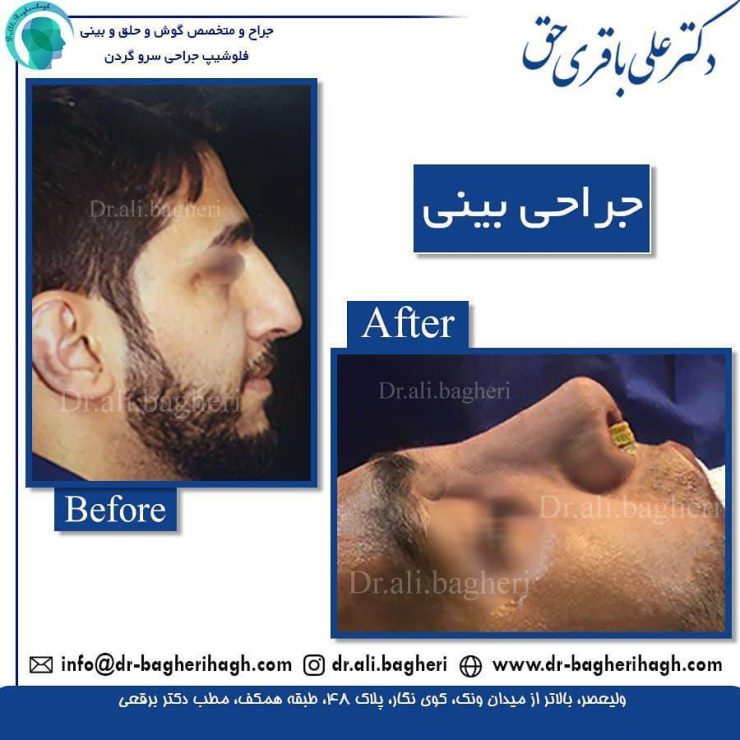 جراحی بینی به روش باز