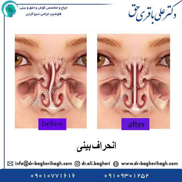 انحراف بینی - دکتر باقری حق