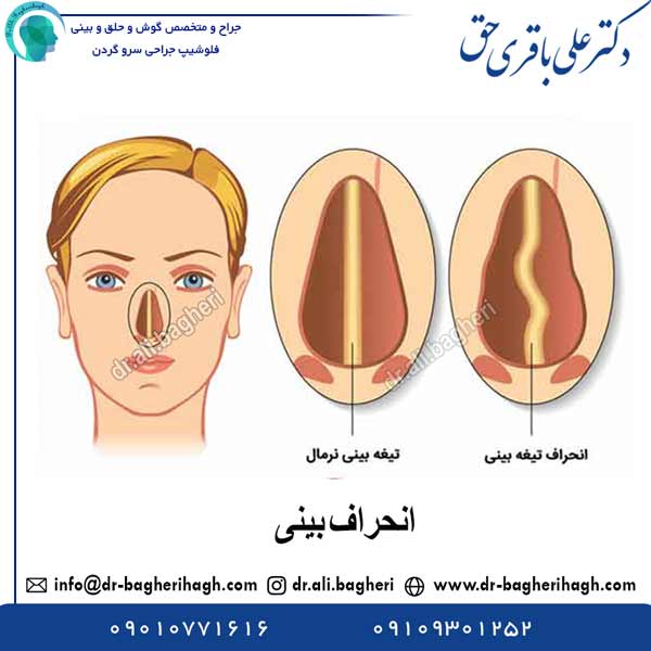 انحراف بینی - دکتر علی باقری حق
