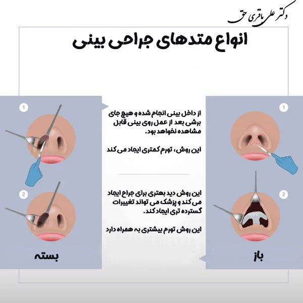 انواع متدهای جراحی بینی - دکتر علی باقری حق