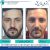 جراحی بینی کج
