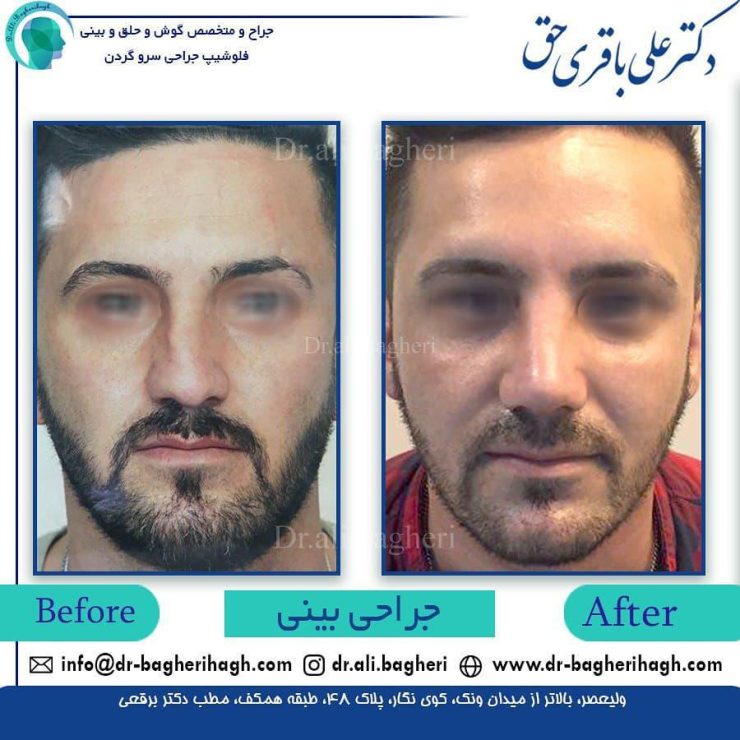 جراحی بینی کج