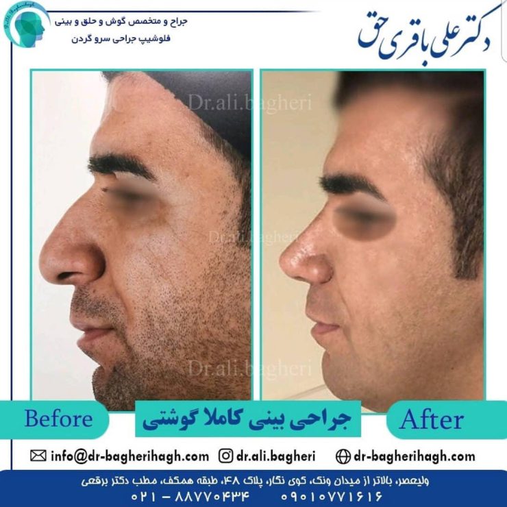 تفاوت جراحی بینی در مردان و زنان 1