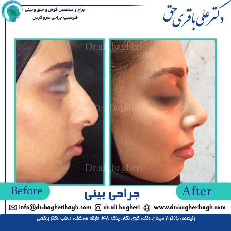 جراحی بینی در بانوان