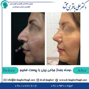 تفاوت بینی گوشتی و بینی استخوانی