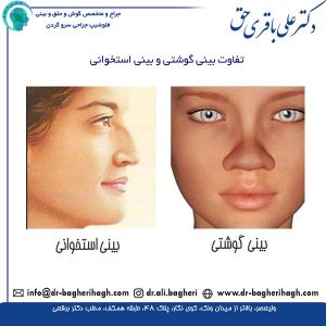  تفاوت بینی گوشتی و بینی استخوانی