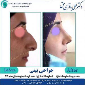 مراحل جراحی بینی