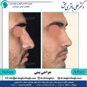 مراحل جراحی بینی
