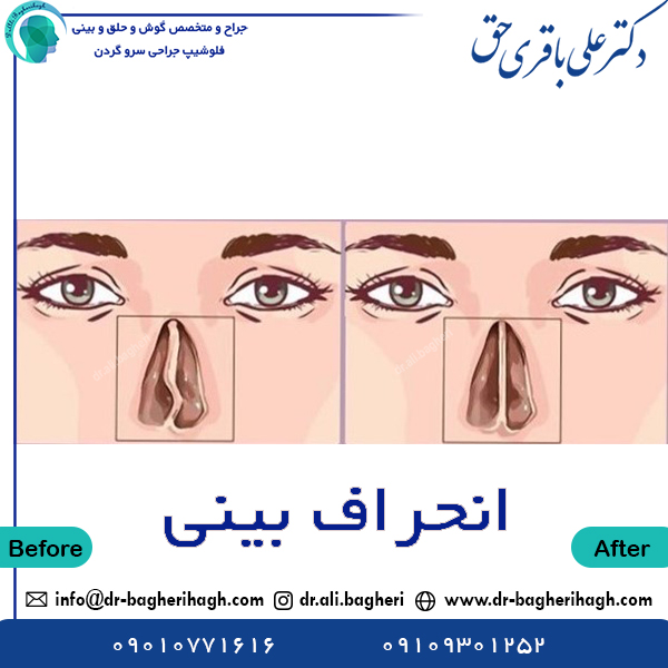 انحراف بینی - دکتر باقری حق