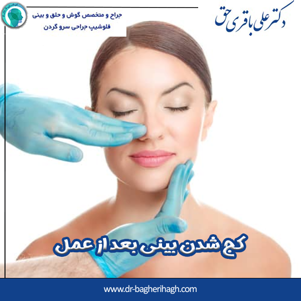 کج شدن بینی بعد از عمل