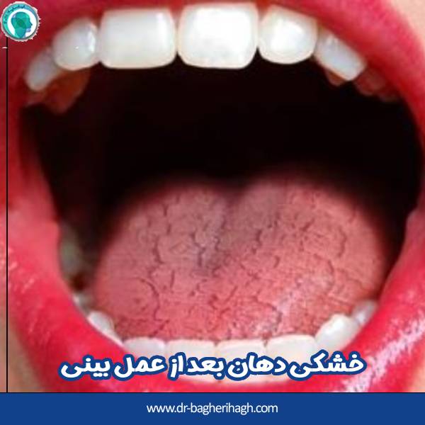 خشکی دهان بعد از عمل بینی