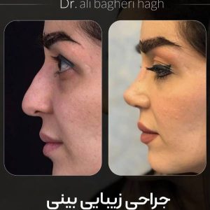 جراحی بینی