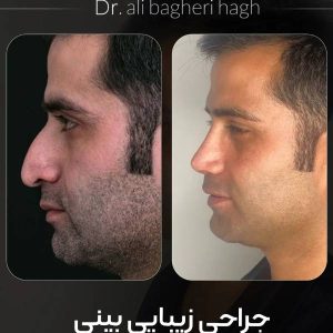 جراحی بینی