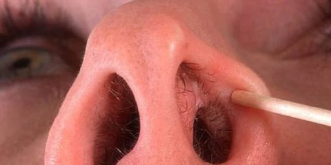 گوشت اضافه بعد از عمل بینی