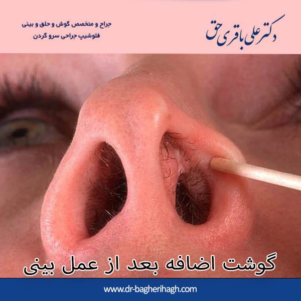 گوشت اضافه بعد از عمل بینی
