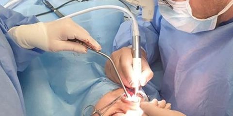 عمل بینی به روش پیزوسرجری